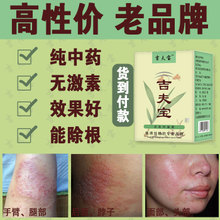濕疹 濕疹引發原因 濕疹癥狀 濕疹如何緩解