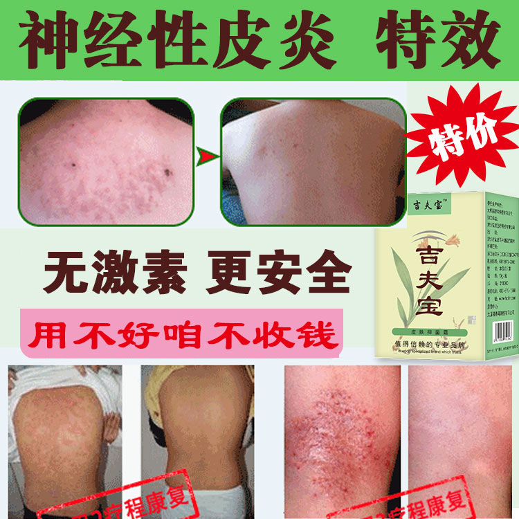 神經性皮炎的癥狀是什么，怎樣**神經性皮炎