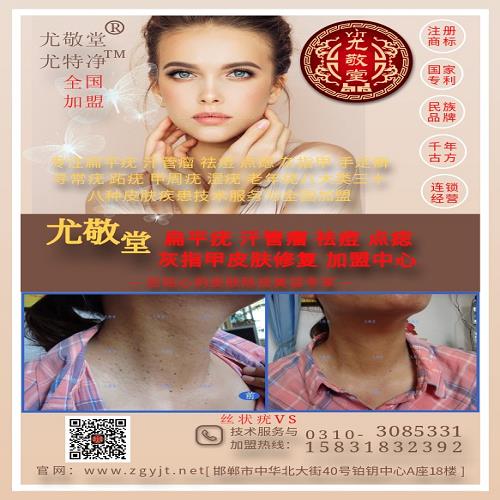 絲狀疣的外用藥_開一個(gè)皮膚管理*店多少錢_邯鄲市邯山區(qū)尤敬堂生物科技有限公司