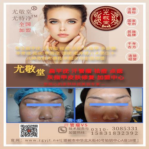 汗管瘤中醫(yī)**方法-開美容院*哪家好-邯鄲市邯山區(qū)尤敬堂生物科技有限公司