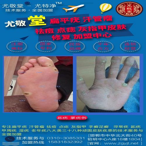 跖疣怎么**/*點斑點痣*哪家好/邯鄲市邯山區尤敬堂生物科技有限公司
