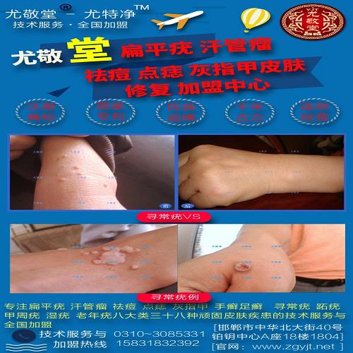 手上尋常疣 修腳店美容店*費(fèi)多少 邯鄲市邯山區(qū)尤敬堂生物科技有限公司