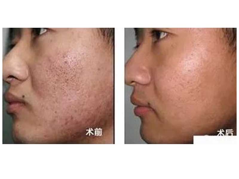 提供河南正規的**毛孔粗大_毛孔粗大怎么辦