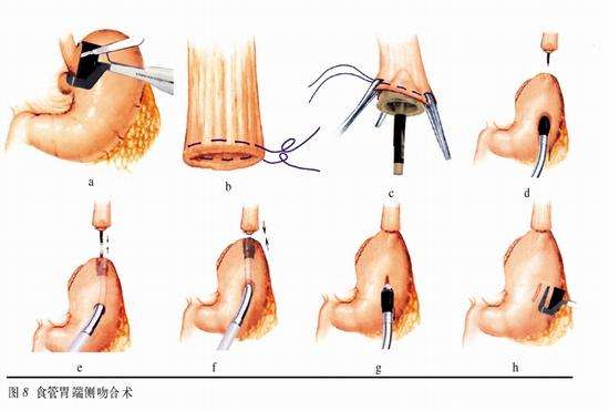 大连强生吻合器型号 价格优惠