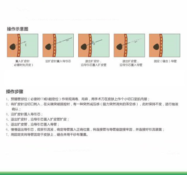 弯型引流管厂家批发