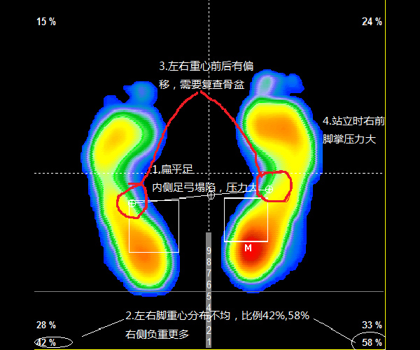 鞋垫式足底压力测试分析-杰森恩柯有限公司