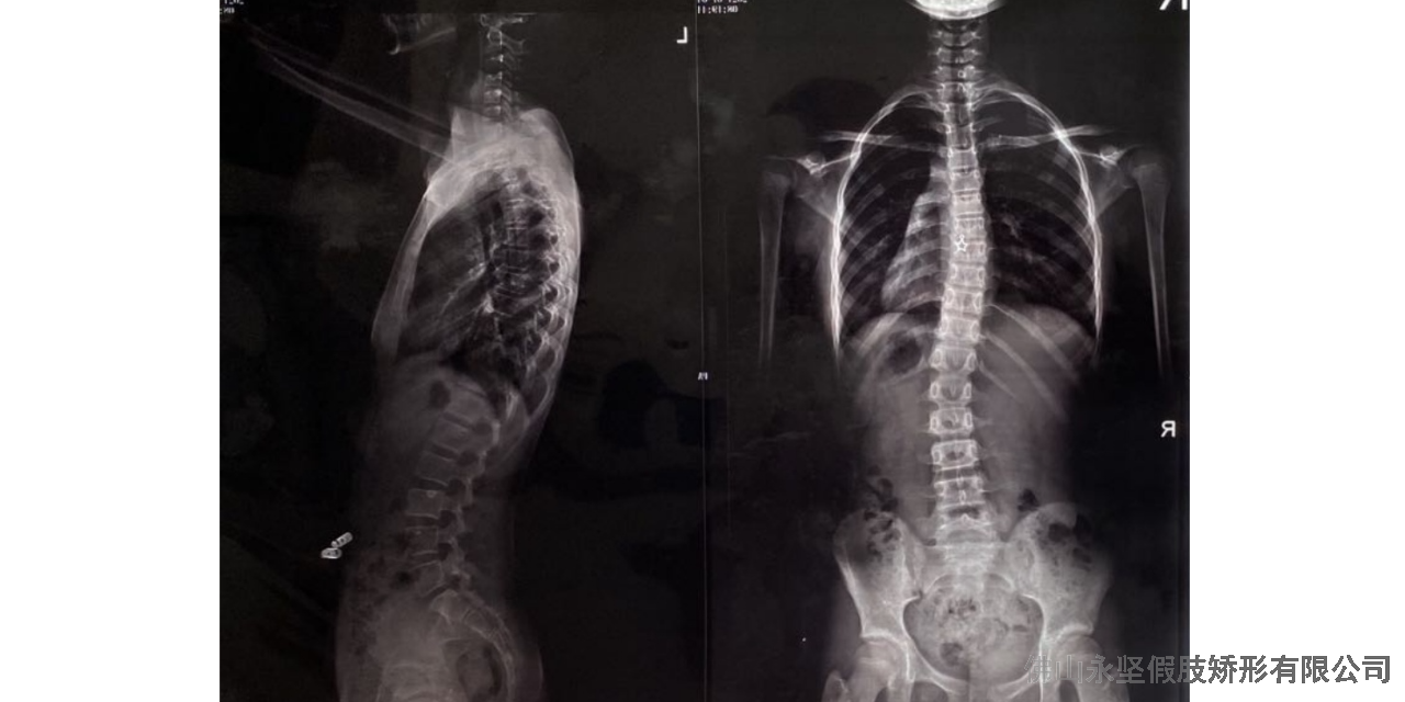 广东15岁脊柱侧弯的定制公司有哪些,脊柱侧弯